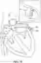 Fig. 17 - Augmented reality solution to optimize the directional approach and therapy delivery of interventional cardiology tools