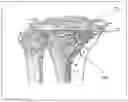 Fig. 06 - Method and device for patient specific instruments for one stage and two stages of revision knee arthroplasty using constraint and hinged knee implant