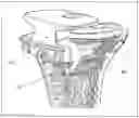 Fig. 08 - Method and device for patient specific instruments for one stage and two stages of revision knee arthroplasty using constraint and hinged knee implant