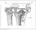 Fig. 09 - Method and device for patient specific instruments for one stage and two stages of revision knee arthroplasty using constraint and hinged knee implant