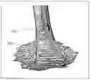 Fig. 16 - Method and device for patient specific instruments for one stage and two stages of revision knee arthroplasty using constraint and hinged knee implant