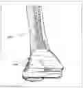 Fig. 17 - Method and device for patient specific instruments for one stage and two stages of revision knee arthroplasty using constraint and hinged knee implant