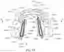 Fig. 43 - MODULAR ORTHODONTIC DEVICES AND METHODS FOR TREATMENT