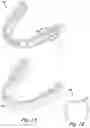 Fig. 02 - Dental implant positioning