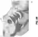Fig. 06 - CBCT imaging of impression having implant locator