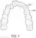 Fig. 09 - Modular aligner devices and methods for orthodontic treatment