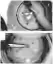 Fig. 01 - DEVICE TO FACILITATE PERFORMING DESCEMET'S MEMBRANE ENDOTHELIAL KERATOPLASTY (DMEK)