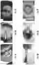 Fig. 04 - DEVICE TO FACILITATE PERFORMING DESCEMET'S MEMBRANE ENDOTHELIAL KERATOPLASTY (DMEK)