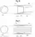 Fig. 13 - Low gradient prosthetic heart valves