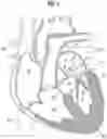 Fig. 02 - Method of implanting a spacer body in a mitral valve