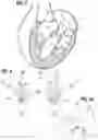 Fig. 03 - Method of implanting a spacer body in a mitral valve