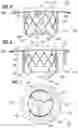 Fig. 05 - Method of implanting a spacer body in a mitral valve