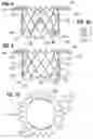 Fig. 06 - Method of implanting a spacer body in a mitral valve