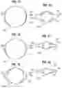 Fig. 08 - Method of implanting a spacer body in a mitral valve