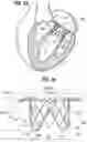 Fig. 09 - Method of implanting a spacer body in a mitral valve