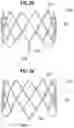 Fig. 10 - Method of implanting a spacer body in a mitral valve