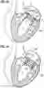 Fig. 13 - Method of implanting a spacer body in a mitral valve