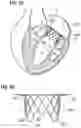 Fig. 16 - Method of implanting a spacer body in a mitral valve