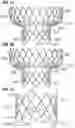 Fig. 17 - Method of implanting a spacer body in a mitral valve