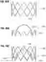 Fig. 19 - Method of implanting a spacer body in a mitral valve