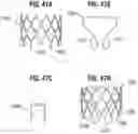 Fig. 20 - Method of implanting a spacer body in a mitral valve