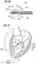 Fig. 25 - Method of implanting a spacer body in a mitral valve
