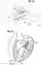 Fig. 26 - Method of implanting a spacer body in a mitral valve