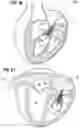 Fig. 30 - Method of implanting a spacer body in a mitral valve