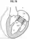 Fig. 32 - Method of implanting a spacer body in a mitral valve