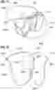 Fig. 33 - Method of implanting a spacer body in a mitral valve
