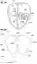 Fig. 37 - Method of implanting a spacer body in a mitral valve
