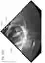 Fig. 45 - Method of implanting a spacer body in a mitral valve