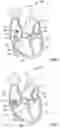 Fig. 04 - SYSTEMS AND METHODS FOR POSITIONING MEDICAL DEVICES RELATIVE TO HEART VALVE ANATOMY