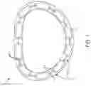 Fig. 02 - Annulus rings with suture clips