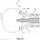 Fig. 34 - Spinal fusion implant