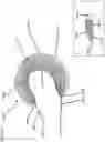 Fig. 15 - Composite joint implant