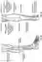 Fig. 04 - TALAR IMPLANT FOR MODIFYING JOINT KINEMATICS