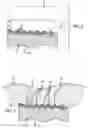 Fig. 04 - Porous surgical implant and method of making same