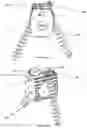Fig. 19 - Bi-directional fixating/locking transvertebral body screw/intervertebral cage stand-alone constructs