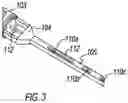 Fig. 04 - System, device, and method for transforaminal lumbar interbody fusion