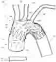 Fig. 01 - Apparatuses to facilitate prosthesis placement