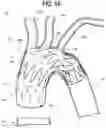 Fig. 02 - Apparatuses to facilitate prosthesis placement