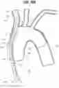 Fig. 14 - Apparatuses to facilitate prosthesis placement