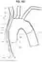 Fig. 15 - Apparatuses to facilitate prosthesis placement
