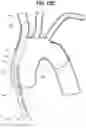 Fig. 16 - Apparatuses to facilitate prosthesis placement