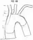 Fig. 17 - Apparatuses to facilitate prosthesis placement