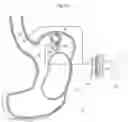 Fig. 19 - Obesity treatment