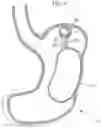 Fig. 20 - Obesity treatment