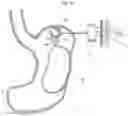 Fig. 22 - Obesity treatment
