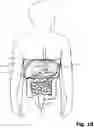 Fig. 05 - Device for the external application of a local compressive force below the costal arch of a patient to reduce the stomach volume